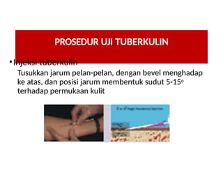Tubercolin Uji tuberkulin Mantoux Test pada penderita Tuberculosis | PPTX