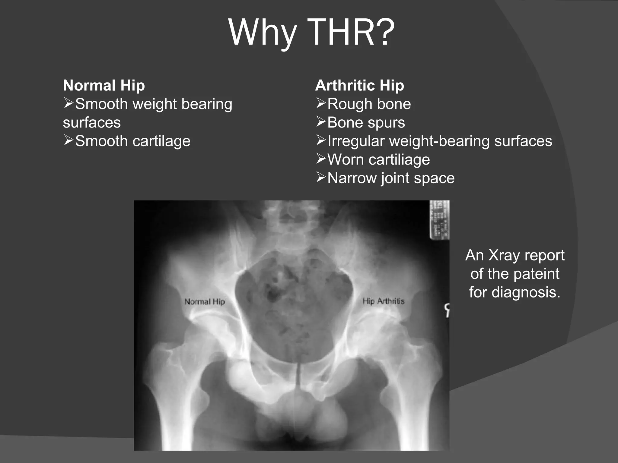 Why THR? Normal Hip Smooth weight bearing surfaces Smooth cartilage Arthritic Hip Rough bone Bone spurs Irregular weight-bearing surfaces Worn cartiliage Narrow joint space An Xray report of the pateint for diagnosis. 