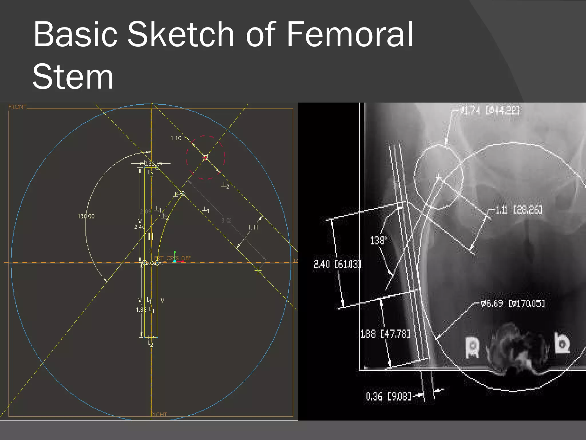 Basic Sketch of Femoral Stem  