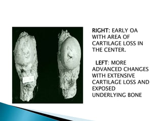 RIGHT: EARLY OA
WITH AREA OF
CARTILAGE LOSS IN
THE CENTER.
LEFT: MORE
ADVANCED CHANGES
WITH EXTENSIVE
CARTILAGE LOSS AND
EXPOSED
UNDERLYING BONE
 