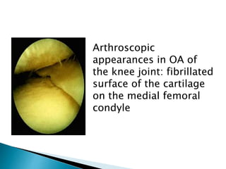 Arthroscopic
appearances in OA of
the knee joint: fibrillated
surface of the cartilage
on the medial femoral
condyle
 