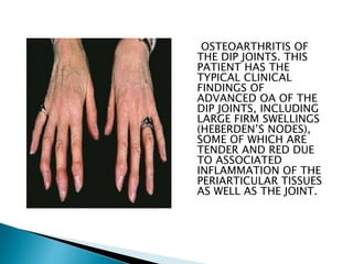 OSTEOARTHRITIS OF
THE DIP JOINTS. THIS
PATIENT HAS THE
TYPICAL CLINICAL
FINDINGS OF
ADVANCED OA OF THE
DIP JOINTS, INCLUDING
LARGE FIRM SWELLINGS
(HEBERDEN’S NODES),
SOME OF WHICH ARE
TENDER AND RED DUE
TO ASSOCIATED
INFLAMMATION OF THE
PERIARTICULAR TISSUES
AS WELL AS THE JOINT.
 