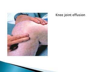 Knee joint effusion
 