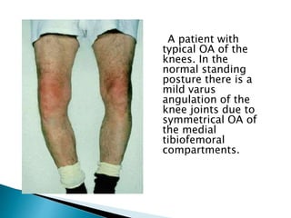 A patient with
typical OA of the
knees. In the
normal standing
posture there is a
mild varus
angulation of the
knee joints due to
symmetrical OA of
the medial
tibiofemoral
compartments.
 