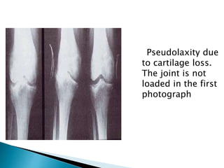 Pseudolaxity due
to cartilage loss.
The joint is not
loaded in the first
photograph
 