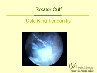 Rotator Cuff
Calcifying Tendonitis
 