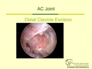AC Joint
Distal Clavicle Excision
 
