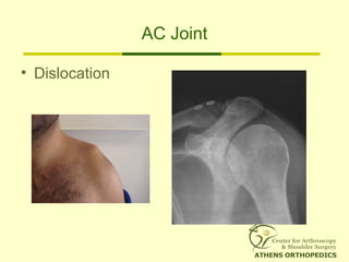 AC Joint
• Dislocation
 