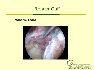 Rotator Cuff
Massive Tears
 