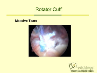 Rotator Cuff
Massive Tears
 