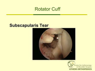 Rotator Cuff
Subscapularis Tear
 