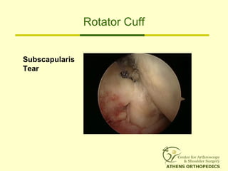 Rotator Cuff
Subscapularis
Tear
 