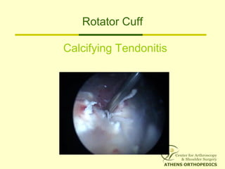Rotator Cuff
Calcifying Tendonitis
 