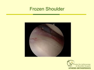 Frozen Shoulder
 
