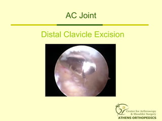 AC Joint
Distal Clavicle Excision
 