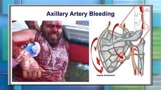 Axillary Artery Bleeding
 