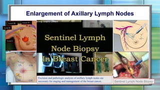 Enlargement of Axillary Lymph Nodes
Sentinel Lymph Node Biopsy
Excision and pathologic analysis of axillary lymph nodes are
necessary for staging and management of the breast cancer.
Level I
Level II
Level III Level IV
UM
LM
UL
LL
 