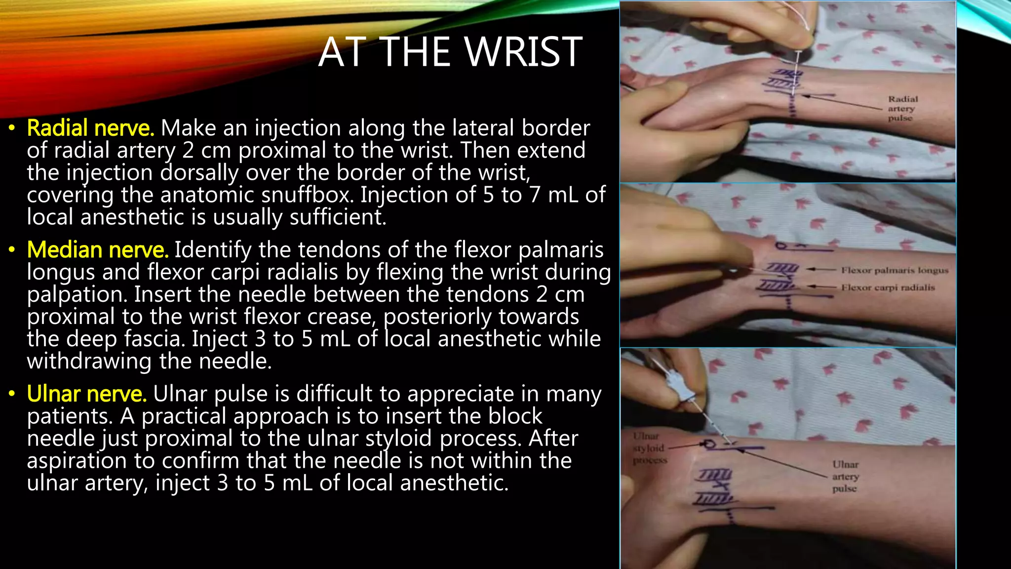Example Regional Block Note Regional Blocks of the Upper Limb and Thorax RRT | PPTX