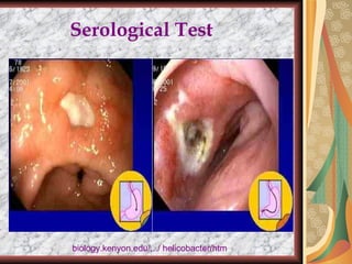 Serological Test  biology.kenyon.edu/.../ helicobacter/htm 