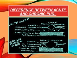 DIFFERENCE BETWEEN ACUTE
AND CHRONIC PUD:
 