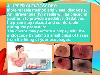 4. UPPER GI ENDOSCOPY:
More reliable method and visual diagnosis.
An intravenous (IV) needle will be placed in
your arm to provide a sedative. Sedatives
help you stay relaxed and comfortable
during the procedure.
The doctor may perform a biopsy with the
endoscope by taking a small piece of tissue
from the lining of your esophagus.
 