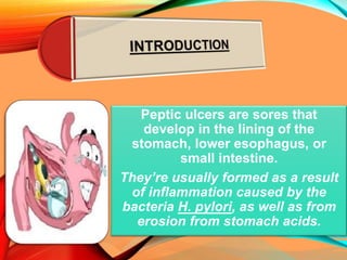 Peptic ulcers are sores that
develop in the lining of the
stomach, lower esophagus, or
small intestine.
They’re usually formed as a result
of inflammation caused by the
bacteria H. pylori, as well as from
erosion from stomach acids.
 