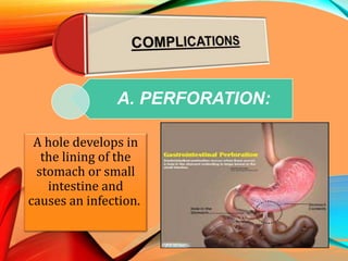 A. PERFORATION:
A hole develops in
the lining of the
stomach or small
intestine and
causes an infection.
 