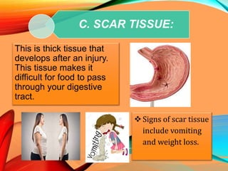 C. SCAR TISSUE:
This is thick tissue that
develops after an injury.
This tissue makes it
difficult for food to pass
through your digestive
tract.
Signs of scar tissue
include vomiting
and weight loss.
 