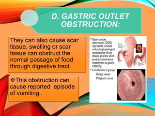 D. GASTRIC OUTLET
OBSTRUCTION:
They can also cause scar
tissue, swelling or scar
tissue can obstruct the
normal passage of food
through digestive tract.
This obstruction can
cause reported episode
of vomiting .
 