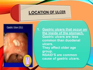 1. Gastric ulcers that occur on
the inside of the stomach.
Gastric ulcers are less
common than duodenal
ulcers.
They affect older age
group.
NSAID’S are common
cause of gastric ulcers.
 