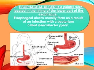 3. ESOPHAGEAL ULCER is a painful sore
located in the lining of the lower part of the
esophagus.
Esophageal ulcers usually form as a result
of an infection with a bacterium
called helicobacter pylori.
 