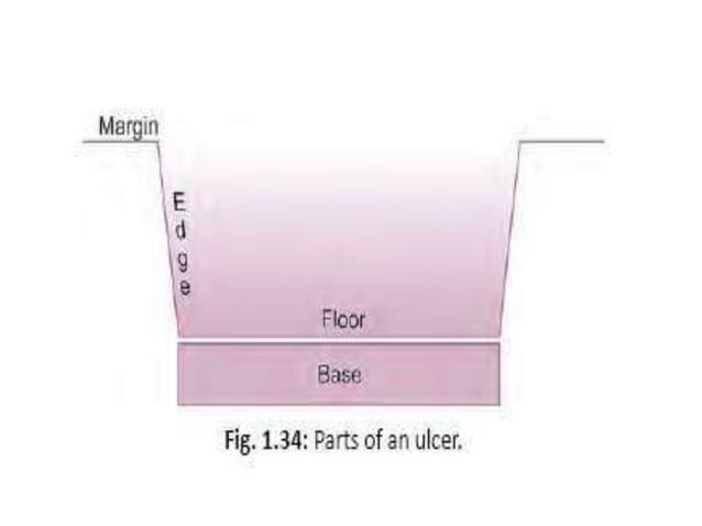Ulcer 190501174026 Pptx