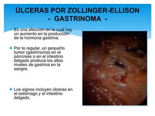 ÚLCERAS POR ZOLLINGER-ELLISON
- GASTRINOMA -
 Es una afección en la cual hay
un aumento en la producción
de la hormona gastrina.
 Por lo regular, un pequeño
tumor (gastrinoma) en el
páncreas o en el intestino
delgado produce los altos
niveles de gastrina en la
sangre.
 Los signos incluyen úlceras en
el estómago y el intestino
delgado.
 
