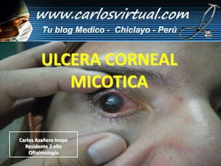 Carlos Azañero Inope
Residente 2 año
Oftalmología
ULCERA CORNEAL
MICOTICA
 