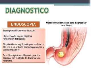ENDOSCOPIA
Estaexploración permite detectar:
• Detecciónde úlceras pépticas
• Obtención debiopsias:
Biopsias de antro y fundus para realizar un
Clo-test o un estudio anatomopatológico y
la existencia deHP
.
En laúlceragástrica obligatorio practicar
biopsias, con el objeto de descartar una
neoplasia.
Método estándar actualpara diagnosticar
una úlcera
 