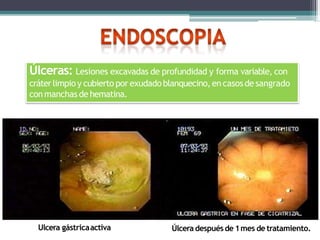 Úlceras: Lesiones excavadas de profundidad y forma variable, con
cráterlimpio y cubierto por exudado blanquecino, en casosde sangrado
conmanchas de hematina.
Ulcera gástricaactiva Úlcera despuésde 1mes de tratamiento.
 