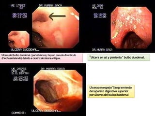 Ulcera del bulboduodenal (parte blanca), hay un pseudo divertículo
(Flechaseñalando) debido a cicatriz de úlceraantigua. "Ulceraensal y pimienta" bulboduodenal.
Ulcerasenespejo"Sangramiento
del aparato digestivo superior
porúlcerasdelbulboduodenal
 