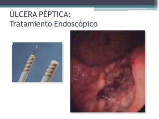ÚLCERA PÉPTICA:
Tratamiento Endoscópico
 