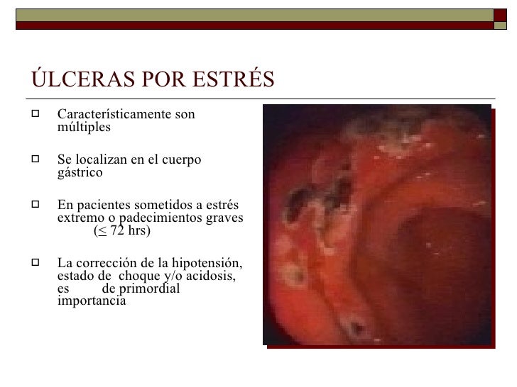 SINDROME ULCEROSO PEPTICO SINDROME ULCEROSO PEPTICO