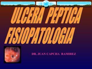 ULCERA  PEPTICA FISIOPATOLOGIA DR. JUAN CAPCHA  RAMIREZ 
