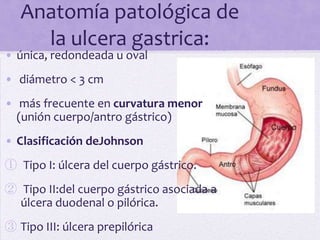 Anatomía patológica de
     la ulcera gastrica:
• única, redondeada u oval
• diámetro < 3 cm
• más frecuente en curvatura menor
  (unión cuerpo/antro gástrico)
• Clasificación deJohnson
① Tipo I: úlcera del cuerpo gástrico.
② Tipo II:del cuerpo gástrico asociada a
  úlcera duodenal o pilórica.
③ Tipo III: úlcera prepilórica
 