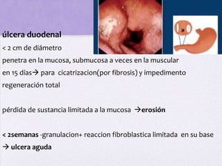 úlcera duodenal
< 2 cm de diámetro
penetra en la mucosa, submucosa a veces en la muscular
en 15 días para cicatrizacion(por fibrosis) y impedimento
regeneración total


pérdida de sustancia limitada a la mucosa erosión


< 2semanas -granulacion+ reaccion fibroblastica limitada en su base
 ulcera aguda
 