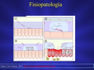 Fisiopatología
Peptic Ulcer Diseae. 2013. http://www.hopkinsmedicine.org
 