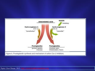 Peptic Ulcer Diseae. 2013. http://www.hopkinsmedicine.org
 