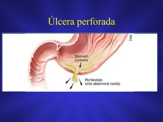 Úlcera perforada
 