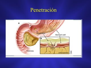 Penetración
 