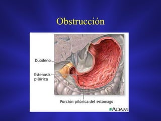 Obstrucción
 