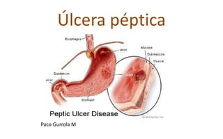 Úlcera péptica
Paco Gurrola M
 