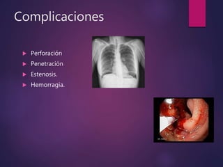 Complicaciones
 Perforación
 Penetración
 Estenosis.
 Hemorragia.
 