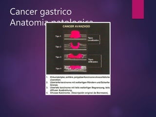 Cancer gastrico
Anatomia patologica.
 
